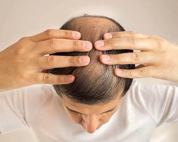 Hair Restoration Treatments
