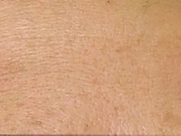 Chemical Peels After