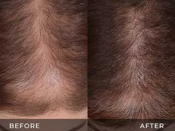 Hair Restoration Before After