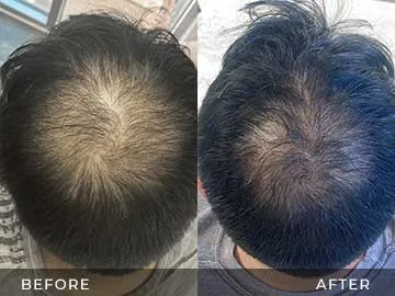 Hair Restoration Before After