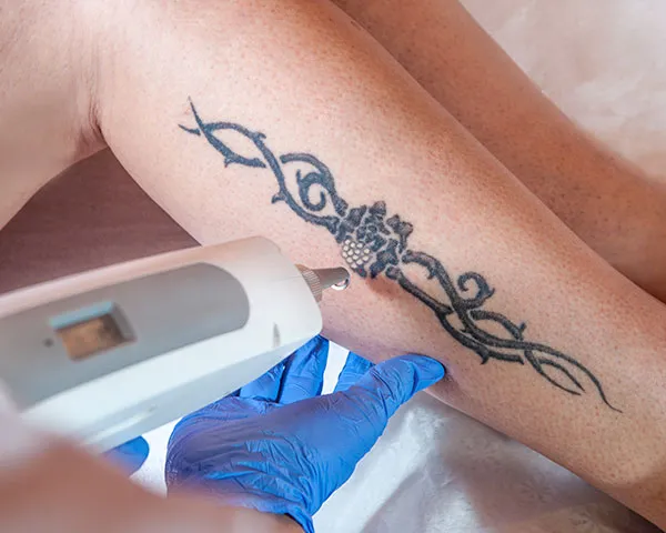Laser tattoo removal Jersey City