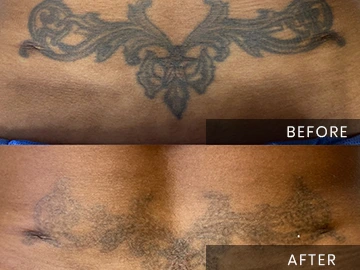 Tattoo Removal Before After