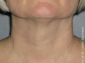 Ultherapy After