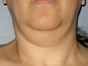 Ultherapy Before